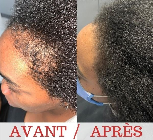Huile essentielle pousse cheveux