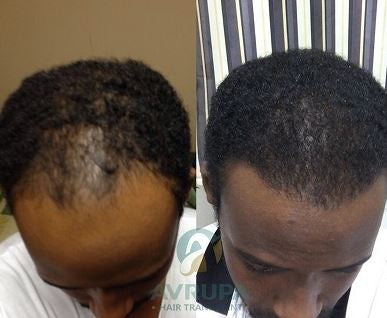 Huile essentielle pousse cheveux